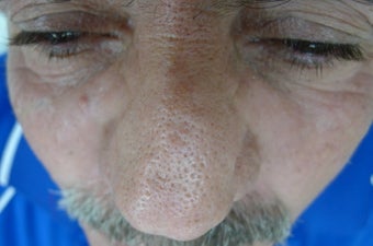 61 year old male with rhinophyma after 1433497