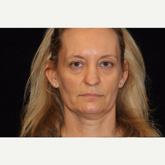 35-44 year old woman treated with Liquid Facelift before 3502735