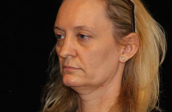 35-44 year old woman treated with Liquid Facelift 3502735