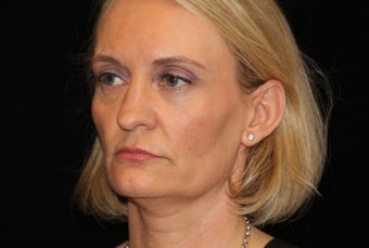 35-44 year old woman treated with Liquid Facelift 3502735
