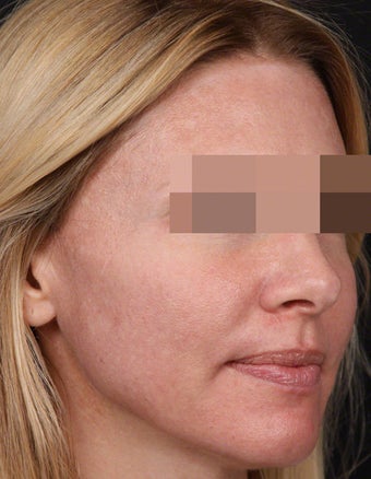 Filler for Under-Eye Hollows after 539863