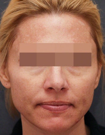 Filler for Under-Eye Hollows 539863