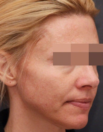 Filler for Under-Eye Hollows before 539863