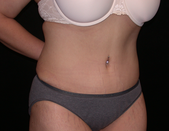 Tummy Tuck after 275748