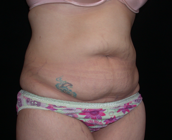 Tummy Tuck before 275748