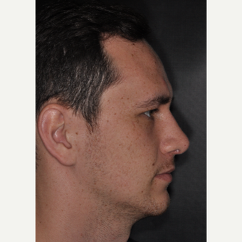18-24 year old man treated with Nose Surgery 6 weeks post-op after 3499671