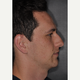 18-24 year old man treated with Nose Surgery 6 weeks post-op before 3499671