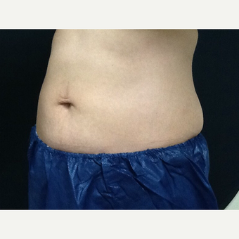 35-44 year old woman treated with CoolSculpting after 3382759