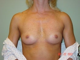 50 yo F 375 HP silicone implant 32A - 32D before 1296479