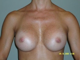 50 yo F 375 HP silicone implant 32A - 32D after 1296479