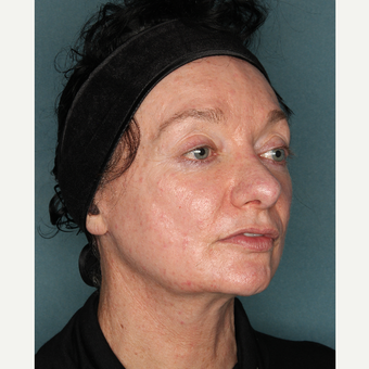 55-64 year old woman treated with Face and Necklift before 3532732