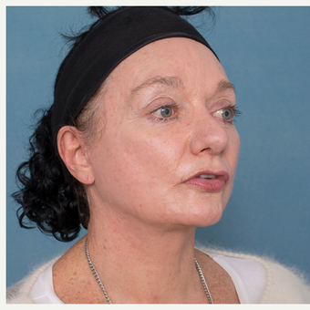 55-64 year old woman treated with Face and Necklift after 3532732