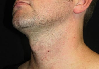33 year old man treated with NeckTite RFAL after 3683612