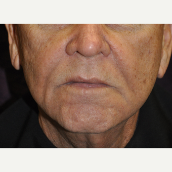 75 and up year old man treated with Juvederm, Restylane & Sculptra after 2881446