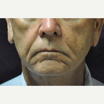 75 and up year old man treated with Juvederm, Restylane & Sculptra before 2881446