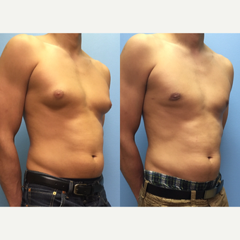 29 year old man treated with Male Breast Reduction before 3174602