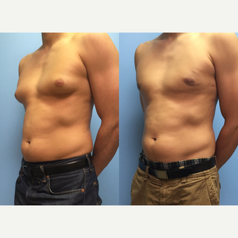 29 year old man treated with Male Breast Reduction after 3174602
