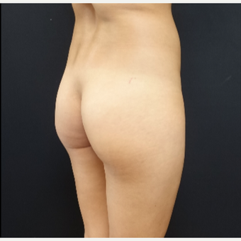 25-34 year old woman treated with Butt Augmentation before 3033228