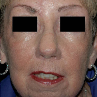 Mohs Surgery after 3711113