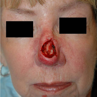 Mohs Surgery before 3711113