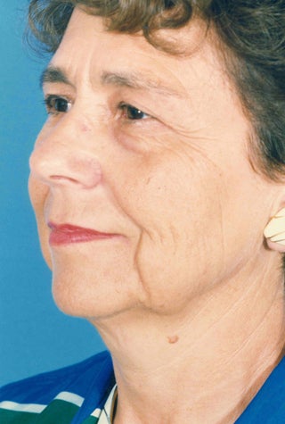 Facelift 1047986
