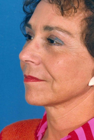 Facelift 1047986