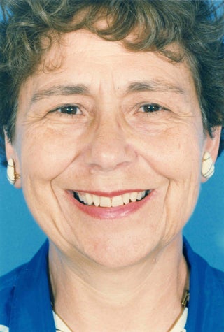 Facelift before 1047986