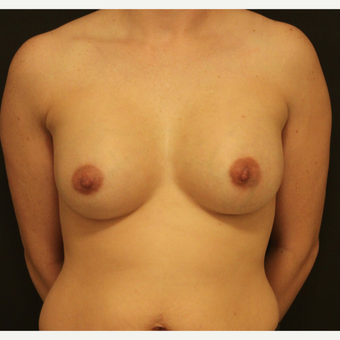 25-34 year old woman treated with Breast Augmentation after 3731652