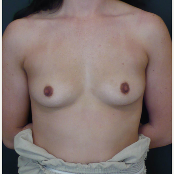 25-34 year old woman treated with Breast Augmentation before 3731652