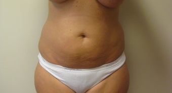 43 year old woman treated with Tummy Tuck before 3108223