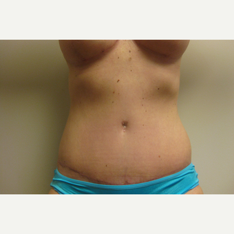 43 year old woman treated with Tummy Tuck after 3108223