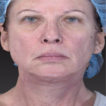 65-74 year old woman treated with Neck Lift with Laser Lift for jaw line tightening after 3266995