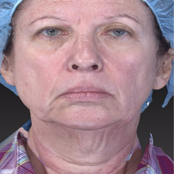 65-74 year old woman treated with Neck Lift with Laser Lift for jaw line tightening before 3266995