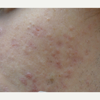 Acne treatments before 3685447