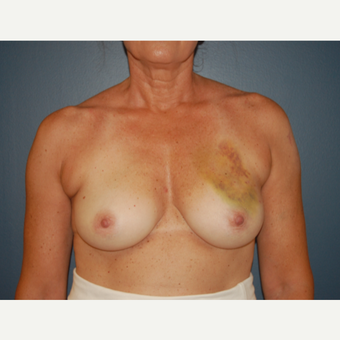 45-54 year old woman treated with Breast Reconstruction before 3446617