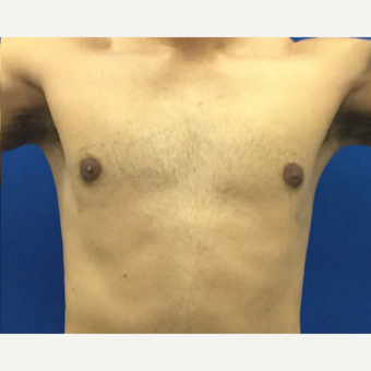 Male Breast Reduction using laser liposuction after 3221104