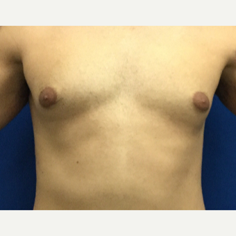 Male Breast Reduction using laser liposuction before 3221104