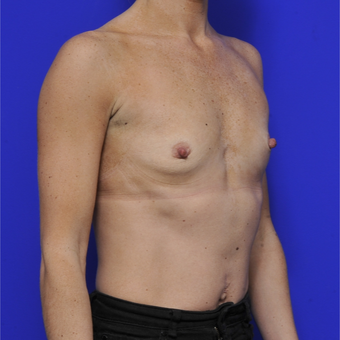35-44 year old woman treated with Breast Augmentation before 3464087
