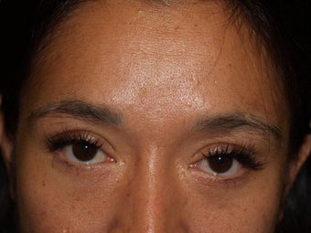 Before, Immediately After, and 1 Year After Eyebrow Transplant Procedure before 569509
