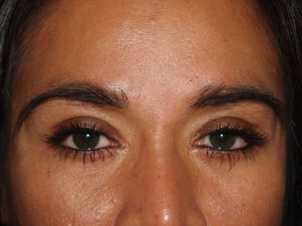 Before, Immediately After, and 1 Year After Eyebrow Transplant Procedure after 569509