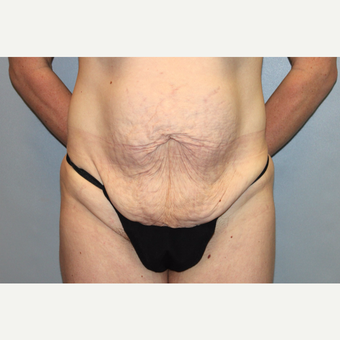 35-44 year old woman treated with Mommy Makeover before 3588682
