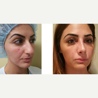 25-34 year old woman treated with Rhinoplasty before 3687068