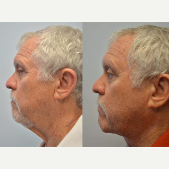 Necklift - 68 year old male with concern of neck “wattle” after 3083850