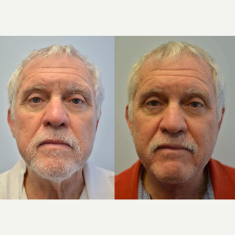 Necklift - 68 year old male with concern of neck “wattle” before 3083850