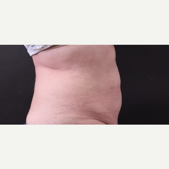62 year old woman treated with CoolSculpting after 3221079