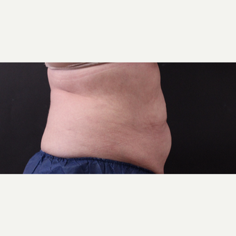62 year old woman treated with CoolSculpting before 3221079