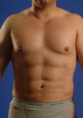 Vaser Hi-def Liposuction Patient after 1364769