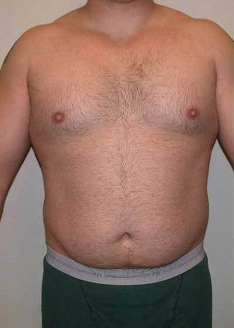 Vaser Hi-def Liposuction Patient before 1364769