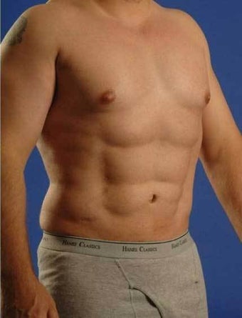 Vaser Hi-def Liposuction Patient 1364769