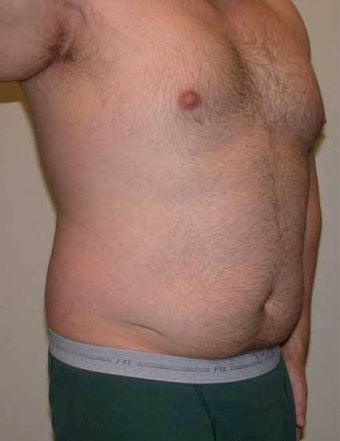 Vaser Hi-def Liposuction Patient 1364769